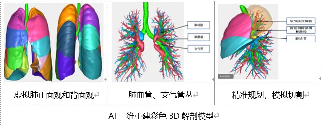 AI三维重建辅助低剂量CT早期肺癌肺段切除术