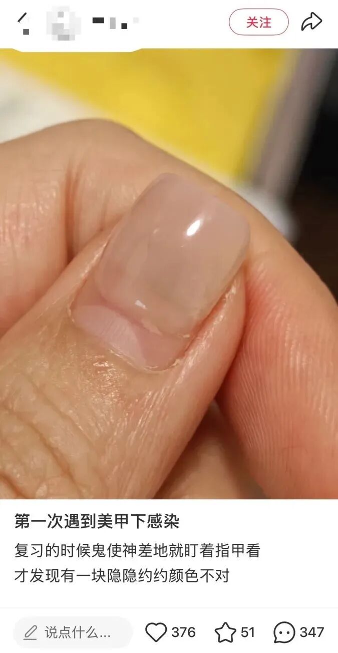 做美甲染上传染病？夏天做足部美甲前必看这些风险(图3)