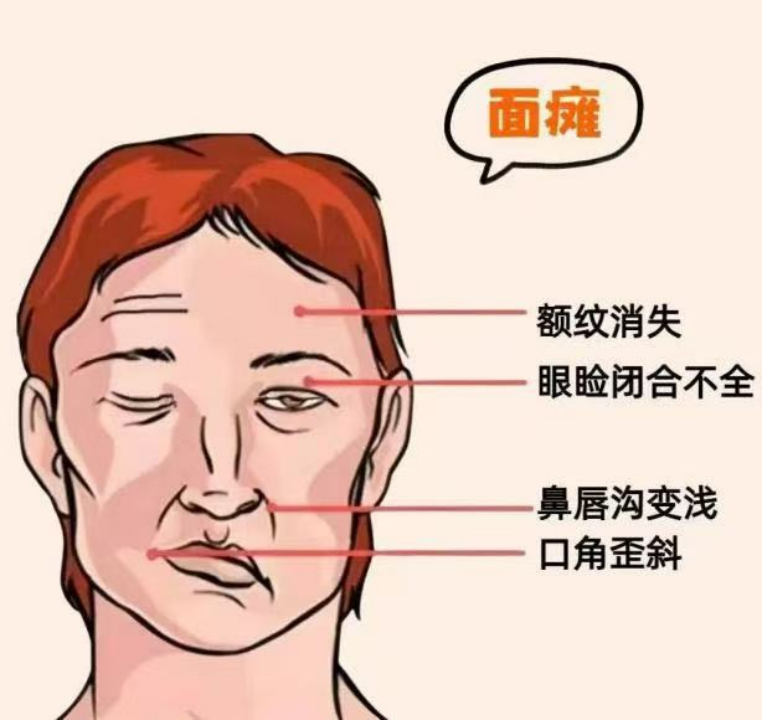 知名艺人患面瘫引关注，一文带你了解面瘫是什么(图3)