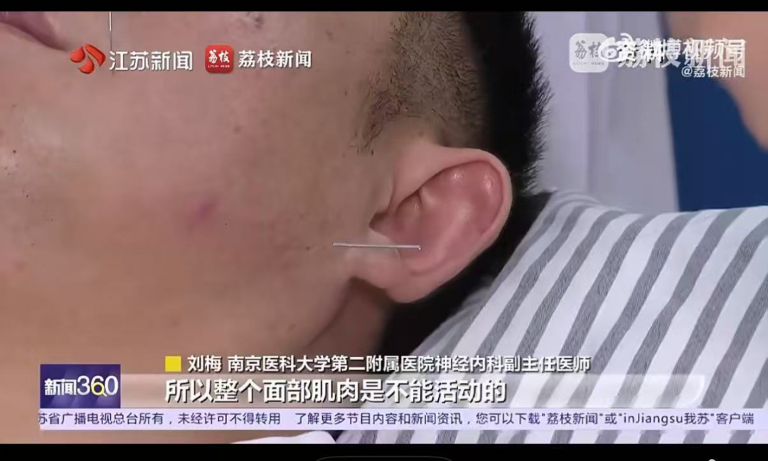 知名艺人患面瘫引关注，一文带你了解面瘫是什么(图4)