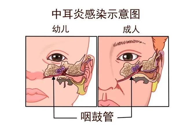 夏季游泳小心耳朵发炎！中耳炎高发期，孩子尤其要注意(图3)