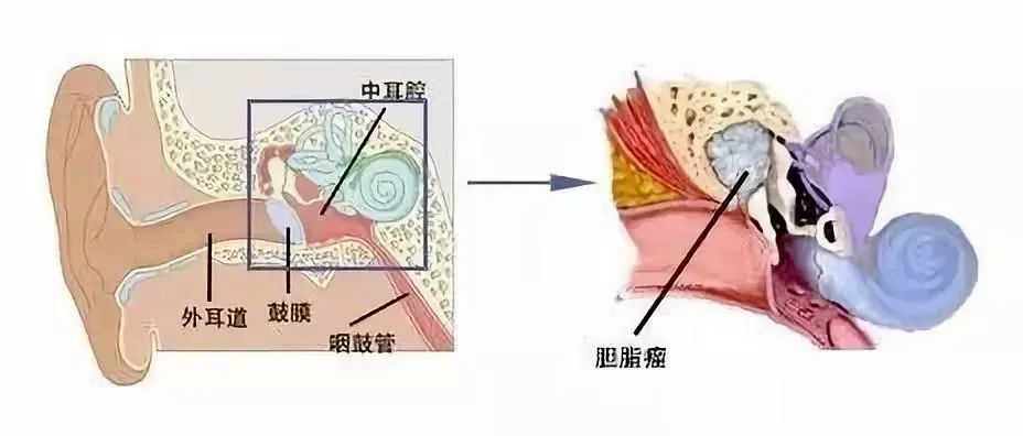 夏季游泳小心耳朵发炎！中耳炎高发期，孩子尤其要注意(图4)