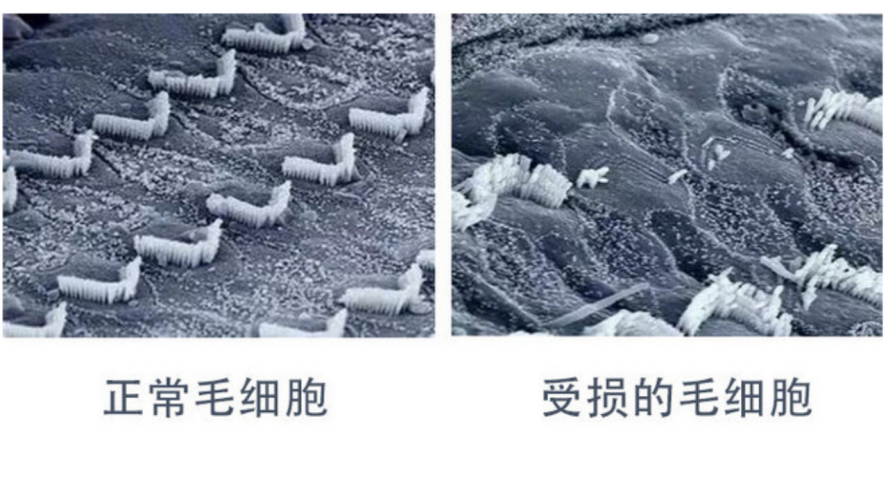 长期戴耳机听力退化,年轻人必知的护耳真相(图2) 长期戴耳机听力退化,年轻人必知的护耳真相(图2)