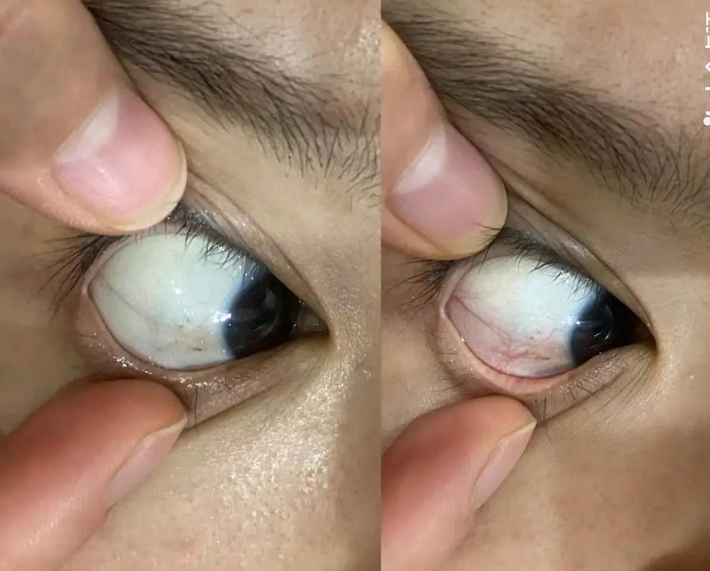 高考后报复式玩手机,眼睛干涩近视加深怎么办(图2) 高考后报复式玩手机,眼睛干涩近视加深怎么办(图2)