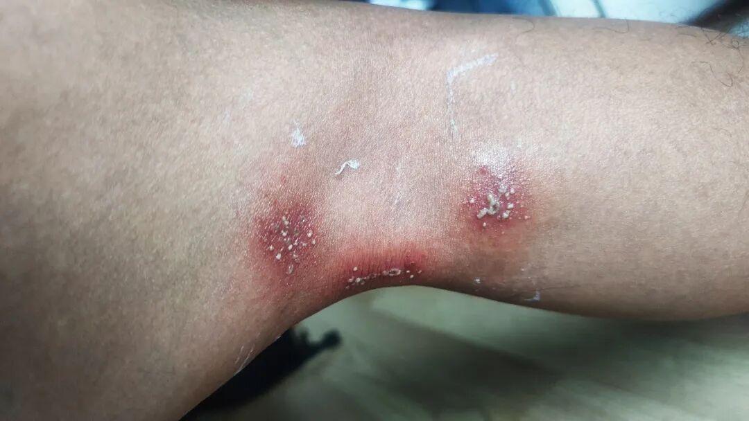 毒隐翅虫千万别拍!沾到毒液会毁容,拍打更严重(图2) 毒隐翅虫千万别拍!沾到毒液会毁容,拍打更严重(图2)