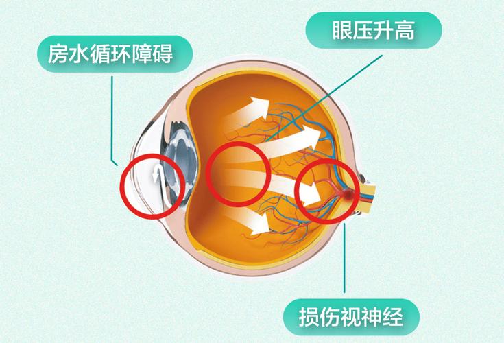 关灯看世界杯?小心眼压飙升诱发青光眼,这样护眼才安全(图2) 关灯看世界杯?小心眼压飙升诱发青光眼,这样护眼才安全(图2)