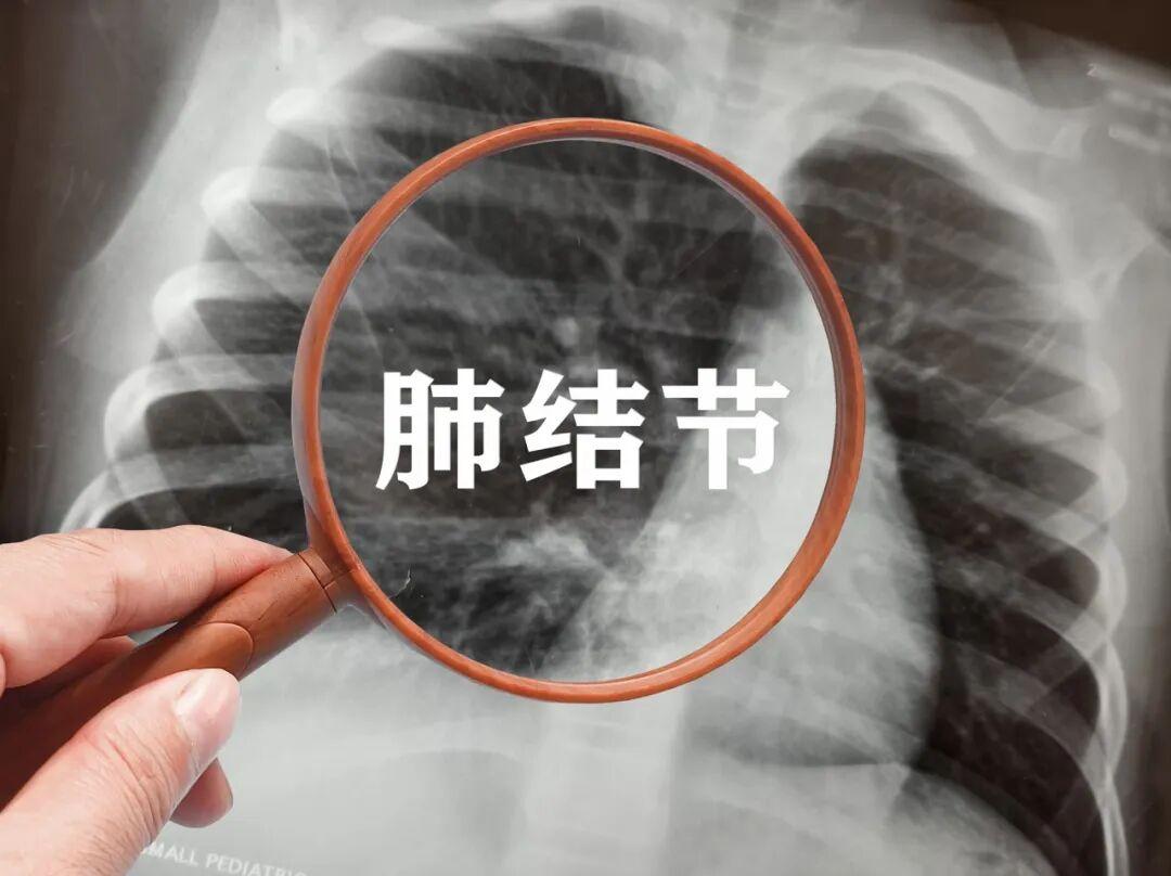 肺结节别乱试偏方!葡萄煮绿豆加醋不靠谱,定期复查才是关键(图2) 肺结节别乱试偏方!葡萄煮绿豆加醋不靠谱,定期复查才是关键(图2)