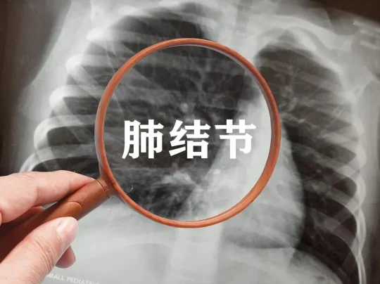 肺结节别乱试偏方！葡萄煮绿豆加醋不靠谱，定期复查才是关键(图2)