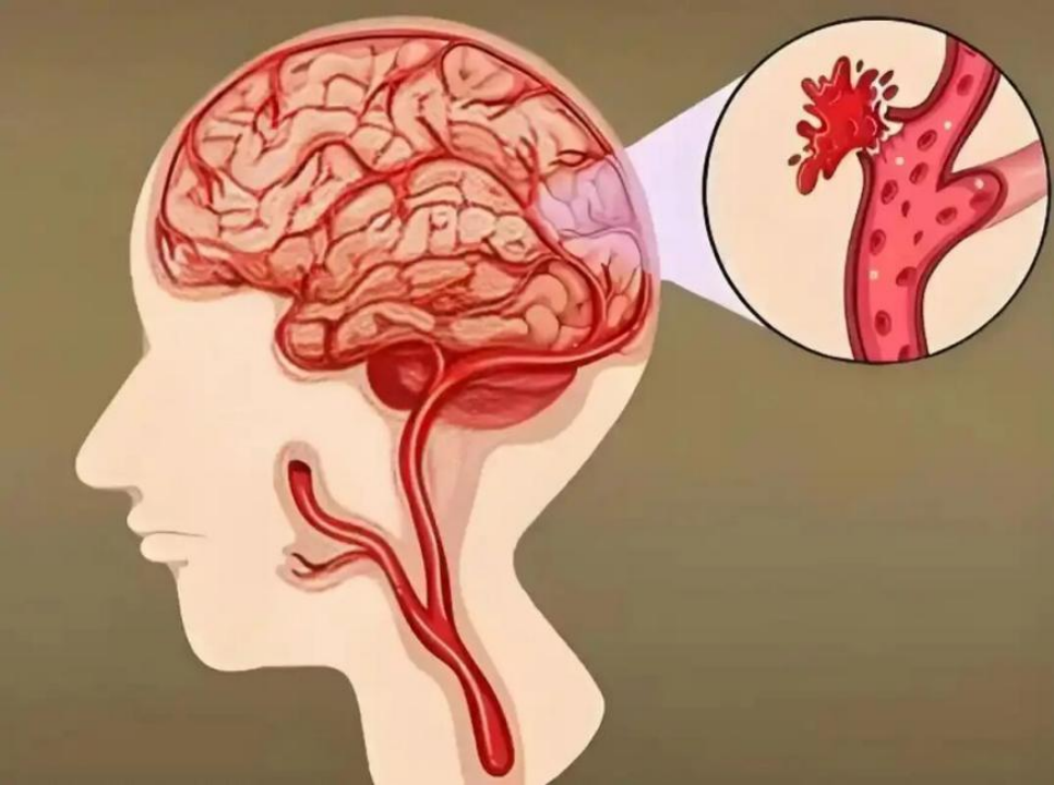 高血压患者注意:绿豆汤喝错会削弱降压药,三天引发脑出血(图3) 高血压患者注意:绿豆汤喝错会削弱降压药,三天引发脑出血(图3)