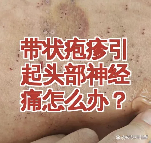 福州球迷熬夜看球须警惕带状疱疹风险:中老年慢病人群健康防线亟待加固(图1) 福州球迷熬夜看球须警惕带状疱疹风险:中老年慢病人群健康防线亟待加固(图1)