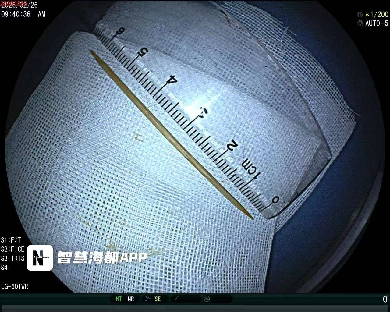 男子腹痛就医，十二指肠竟取出5厘米牙签(图2)