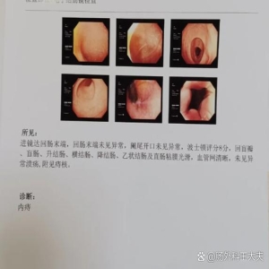 抽血查肠癌不准！别信CEA/CA19-9，肠镜才是早筛金标准