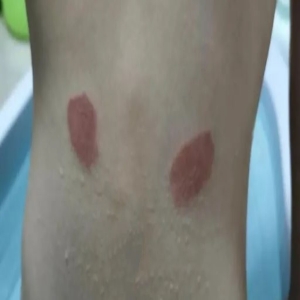 三伏贴别乱贴！不是人人都适合，小心皮肤灼伤起疱