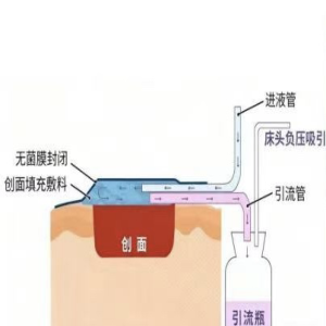 猫狗咬伤伤口深藏细菌？负压引流技术帮您清创排脓