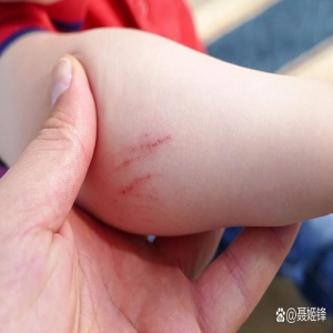 被猫狗抓咬后怎么办？狂犬病暴露分级与紧急处理指南