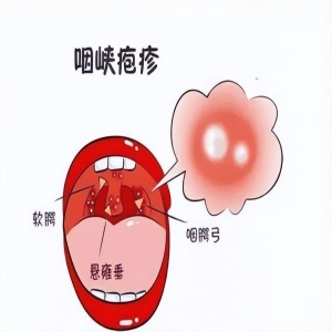 疱疹性咽峡炎和手足口病怎么区分？儿科医生教你识别